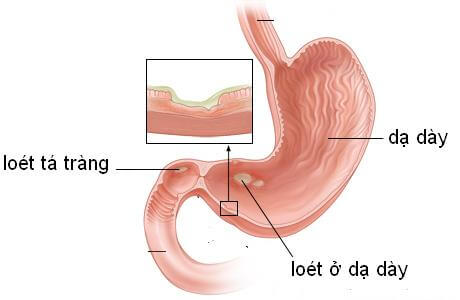Điều trị loét dạ dày tá tràng